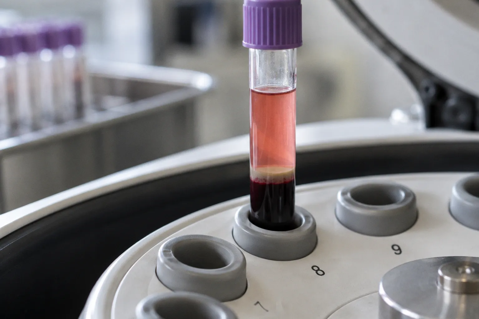 Tube hémolysé au laboratoire : anatomie d'une fausse alerte